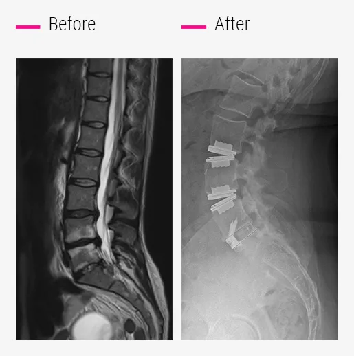 Two mobile and one fixed prosthesis
