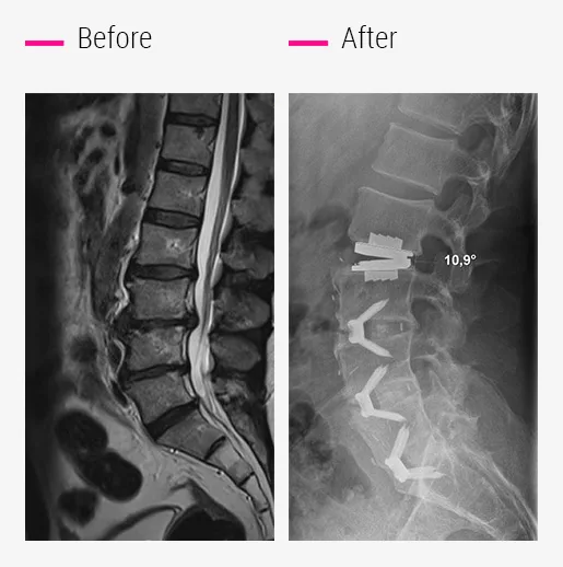 Up to 4 mobile or fixed prostheses