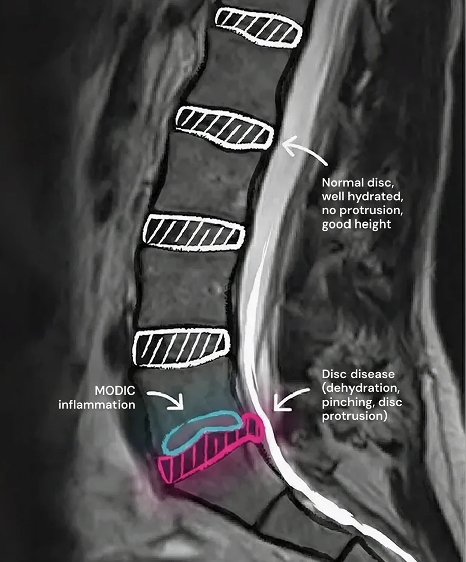 Annotated lumbar spine MRI showing a herniated disc with dehydration and protrusion compressing spinal nerves, compared with normal healthy discs.