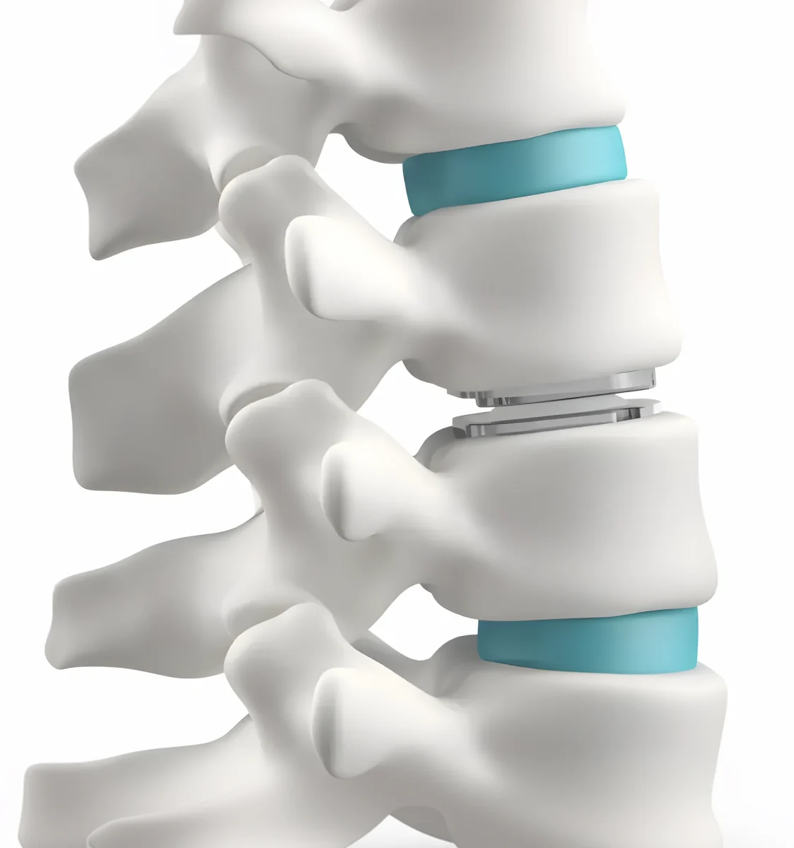 3d render showing a Prodisc® L lumbar total disc replacement in place between two vertebrae in the lumbar spine
