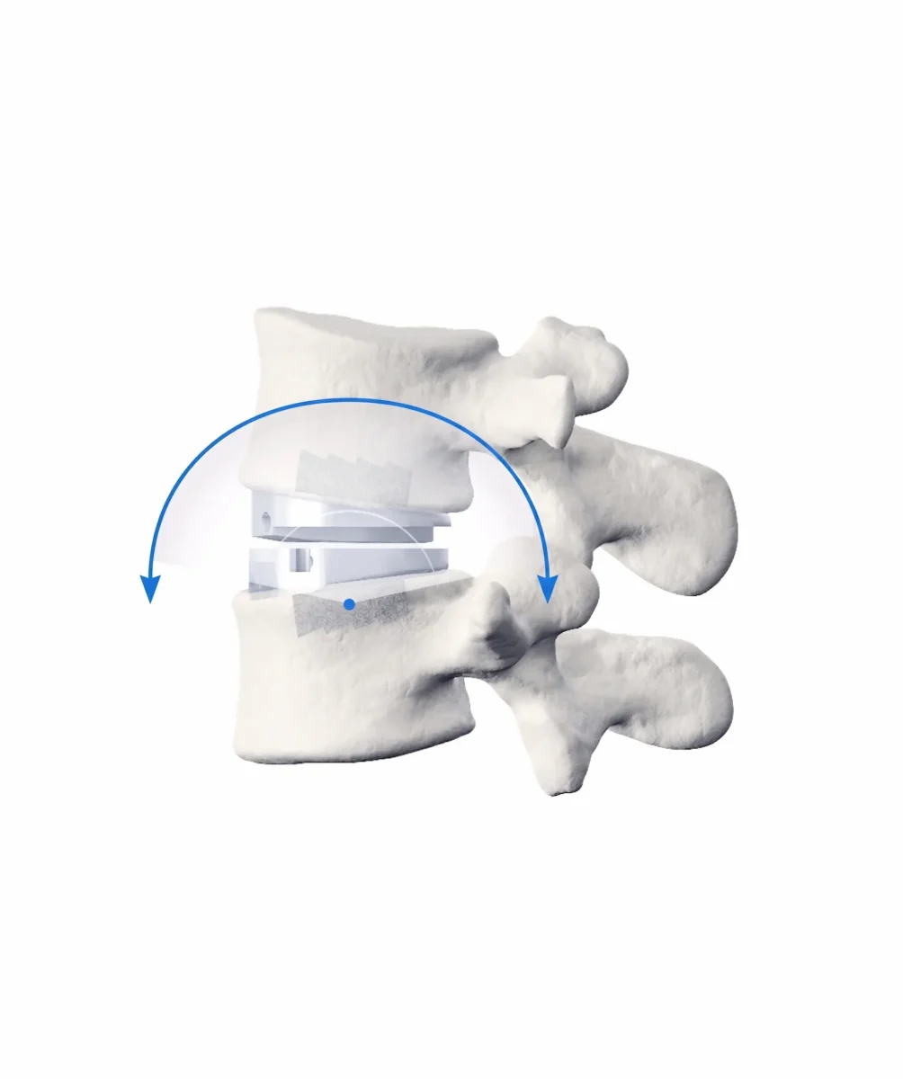 prodisc l implant-in-vertebrae render with motion arc blue